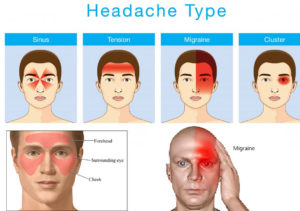 Sinus headaches and Migraine